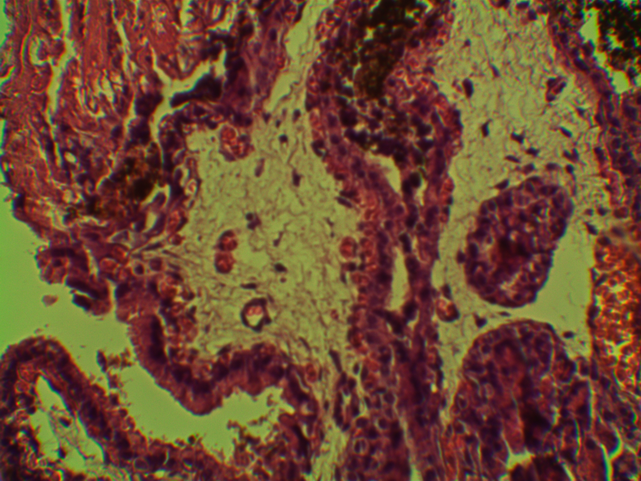 Рис. 3. Незрелая ворсина с периферическим расположением плодовых капилляров (увел. 10 × 40)